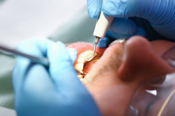 Best Emergency Dental Care for Abscessed Tooth in Shenandoah Farms, VA