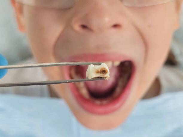Best Broken or Cracked Tooth Emergency Dentist in Shenandoah Farms, VA
